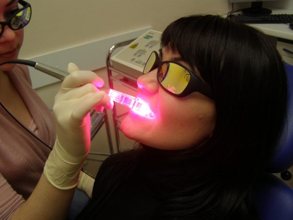 Как добиться лучшего результата при лазерном отбеливании зубов