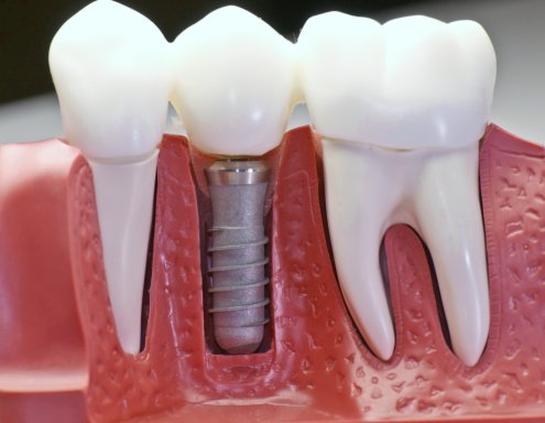 Имплантация зубов – от планов к действиям