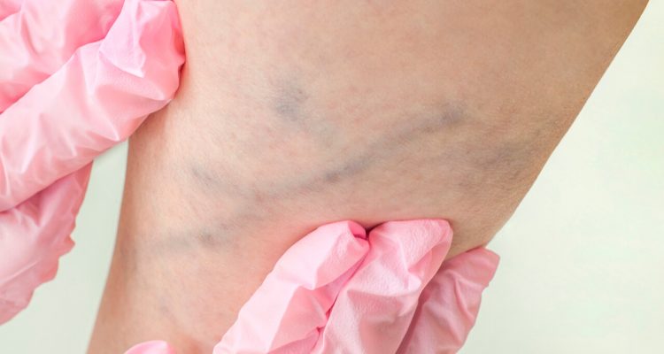 Помогают ли мази от варикоза на самом деле? Истина для женского здоровья