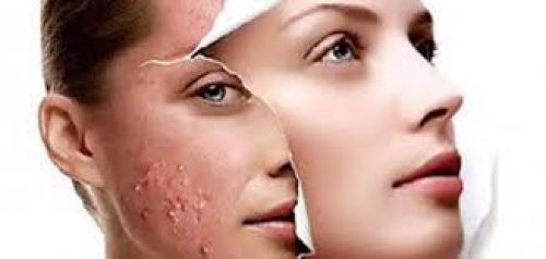 Как избавиться от прыщей: эффективные методы для чистой кожи