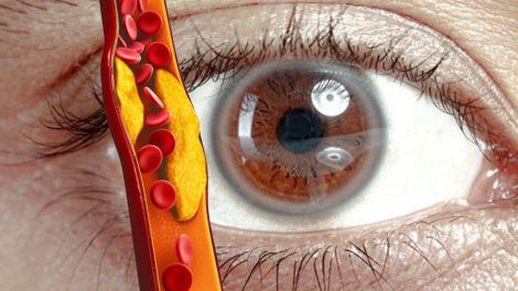 Высокий холестерин: как распознать по первым признакам, важным для женщин