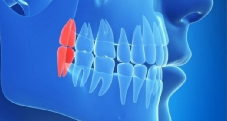 Зубы мудрости: удалять или нет? Все, что нужно знать женщине.
