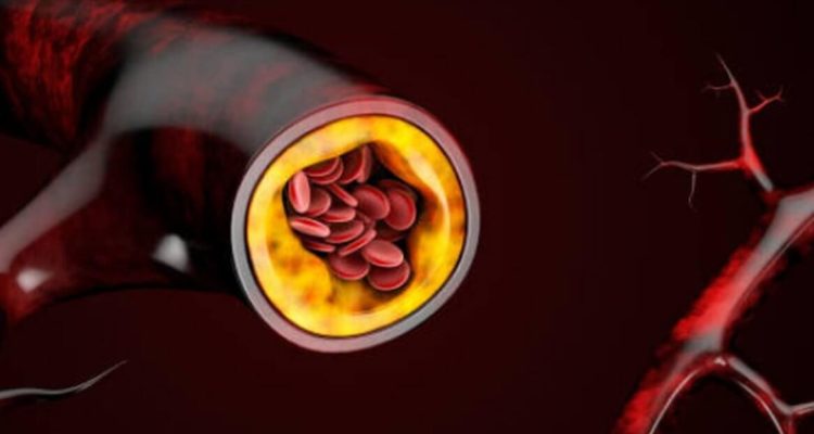 О чем говорят ваши привычки: признаки повышенного холестерина, которые нельзя игнорировать