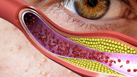 Высокий холестерин: как распознать признаки на теле – советы для женщин