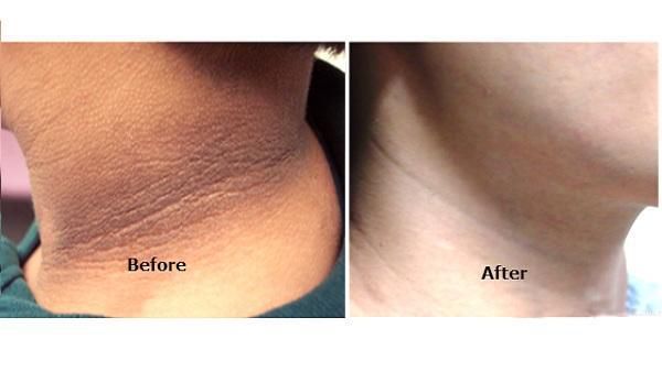 Как убрать морщины на шее: эффективные советы для красоты и молодости