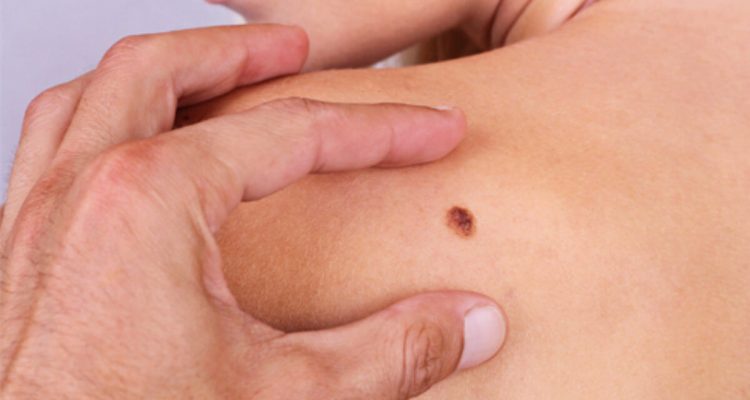 Родинки: когда стоит беспокоиться? Советы дерматолога для женщин