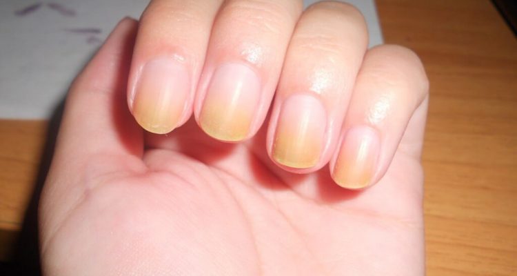 Цвет ногтей: сигналы здоровья, которые нельзя игнорировать