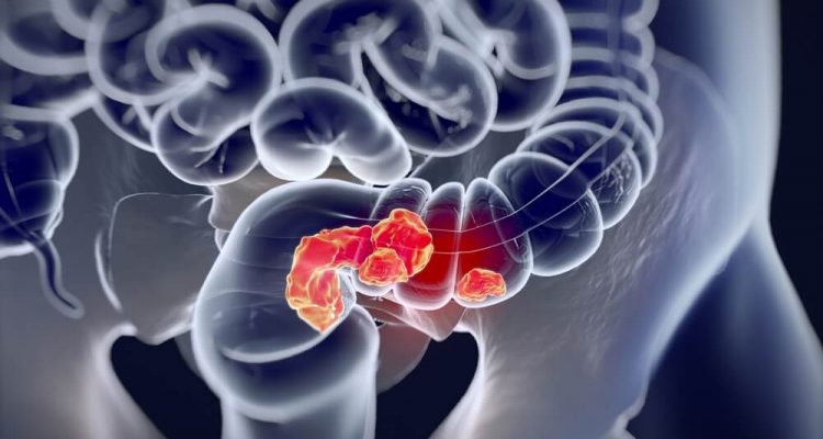 5 шагов к здоровью кишечника: как снизить риск рака