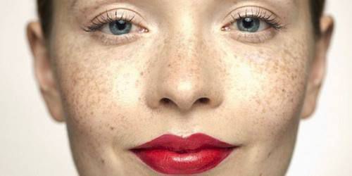 Как избавиться от пигментных пятен: 7 эффективных способов для красивой кожи