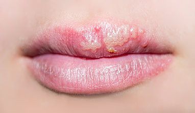 Как избавиться от герпеса: эффективные методы и уход за кожей