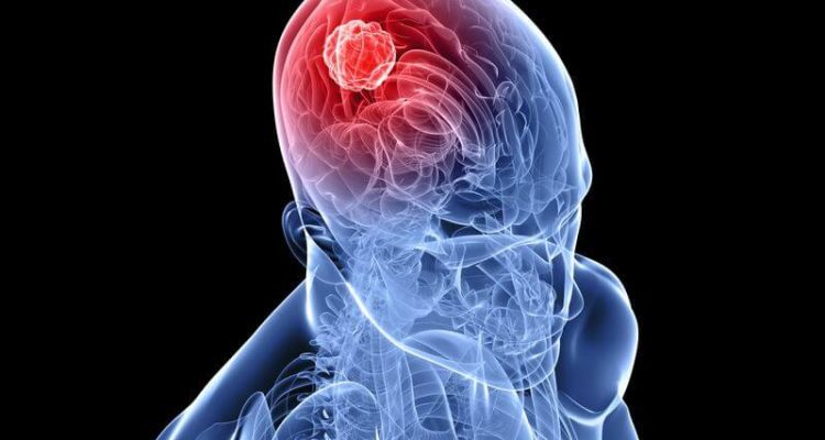 Скрытые признаки опухоли мозга у женщин: на что обратить внимание