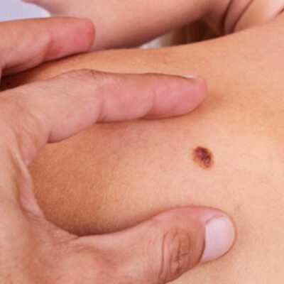 Опасные родинки: где они чаще всего появляются и как распознать угрозу (советы онколога)