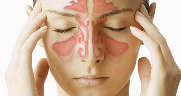 Как отличить острый и хронический синусит: симптомы и диагностика для женщин