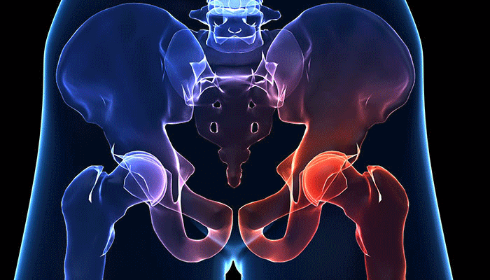 Профилактика и лечение износа тазобедренного сустава: советы для женского здоровья