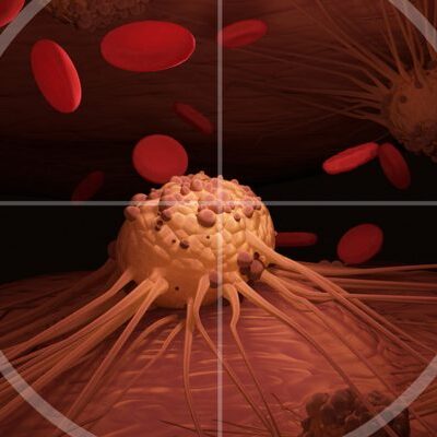 Рак: Как распознать скрытые симптомы, о которых не знает каждая третья женщина