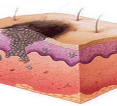 Рак кожи: 5 тревожных симптомов, которые нельзя игнорировать женщинам