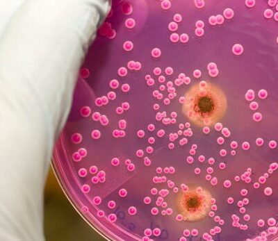 Молочница: причины, симптомы и эффективное лечение для женщин