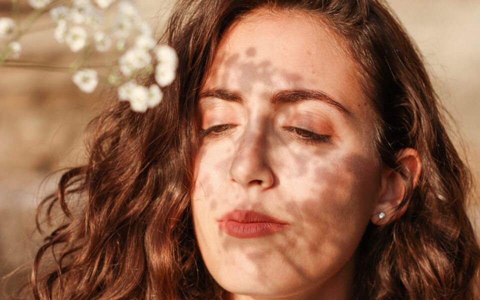 Как солнце влияет на кожу: почему появляются высыпания и как с ними бороться