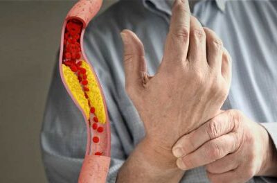 Признаки высокого холестерина: на что обратить внимание, чтобы сохранить женское здоровье