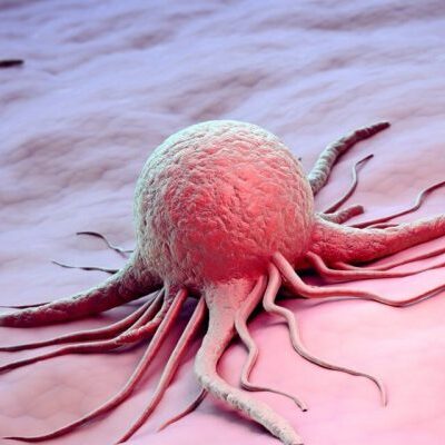 Рак: сколько времени занимает развитие болезни и как его заметить