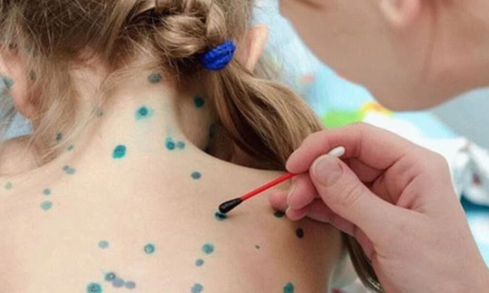 Ветрянка: мифы, реальность и как помочь себе и близким