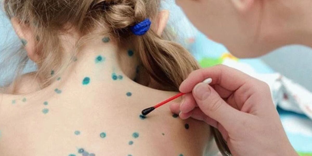 Ветрянка: мифы, реальность и как помочь себе и близким