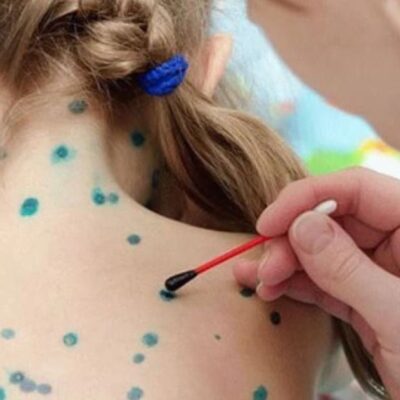 Ветрянка: мифы, реальность и как помочь себе и близким