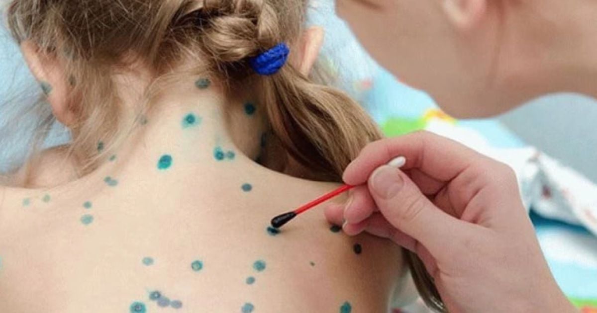 Ветрянка: мифы, реальность и как помочь себе и близким