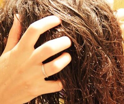 Борьба с перхотью: эффективные методы и домашние средства для красоты волос