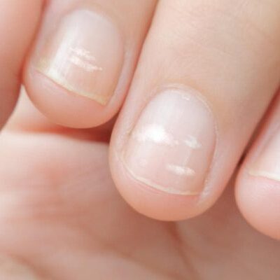 Как ногти расскажут о вашем здоровье: советы дерматолога