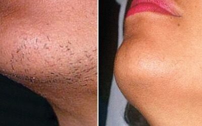 Секреты красоты звезд: как избавиться от нежелательных волос на лице навсегда