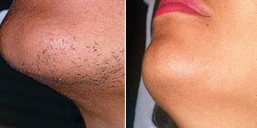 Секреты красоты звезд: как избавиться от нежелательных волос на лице навсегда