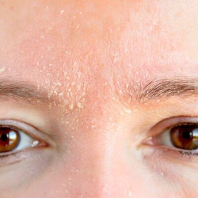 5 ошибок в уходе за кожей, которые провоцируют сухость и шелушение