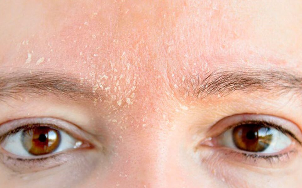 5 ошибок в уходе за кожей, которые провоцируют сухость и шелушение