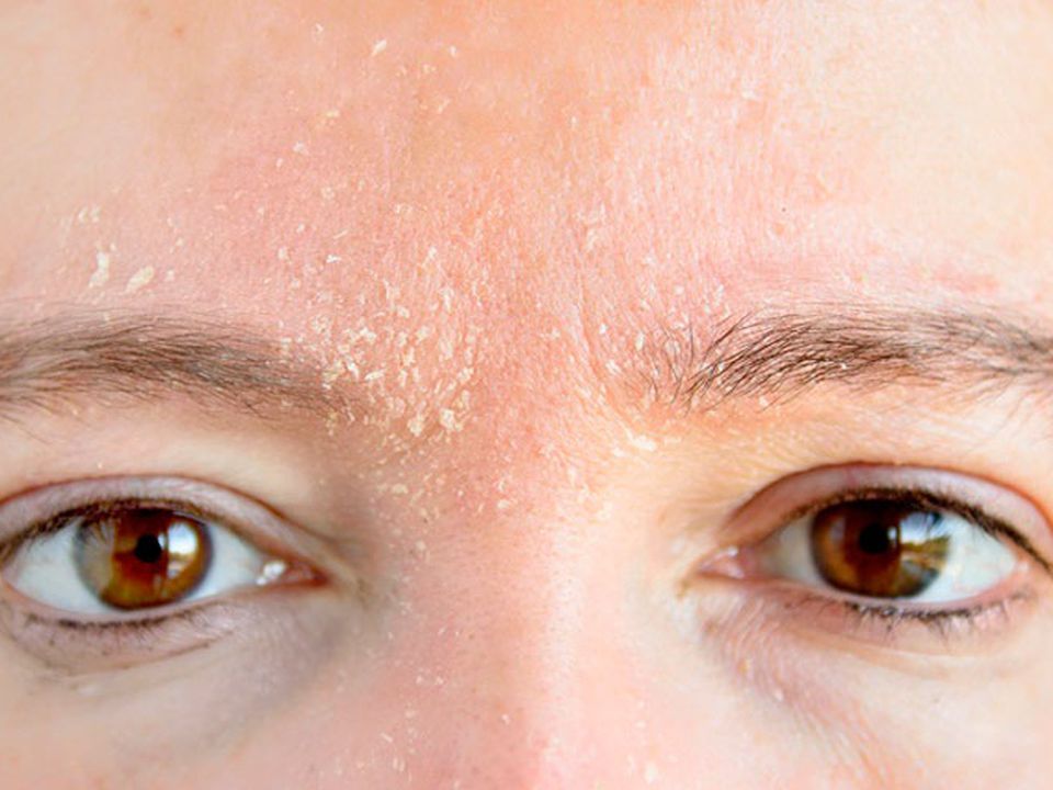 5 ошибок в уходе за кожей, которые провоцируют сухость и шелушение